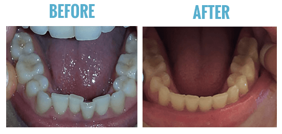 smile care club before after