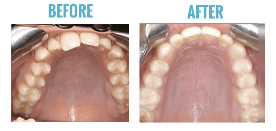 smile direct club results